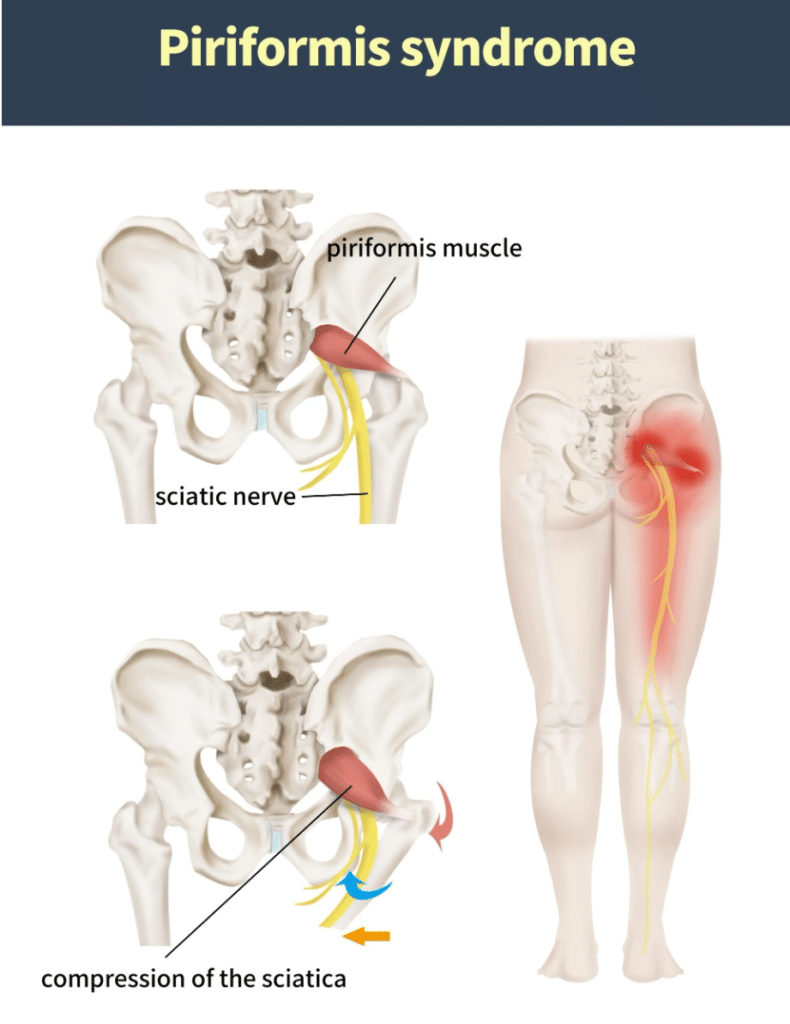 piriformis syndrome in hilliard, oh
