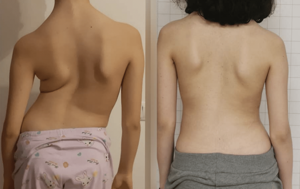 Schroth Method Therapy Columbus Ohio Before and after